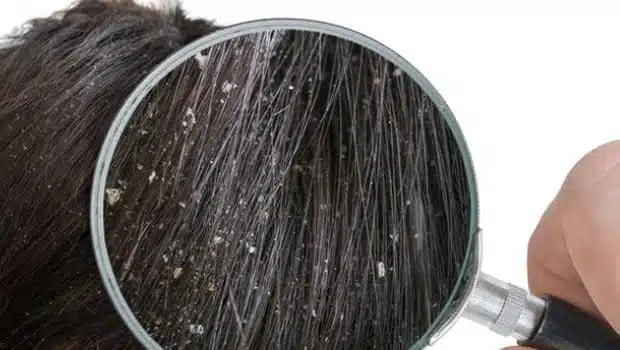 dandruff