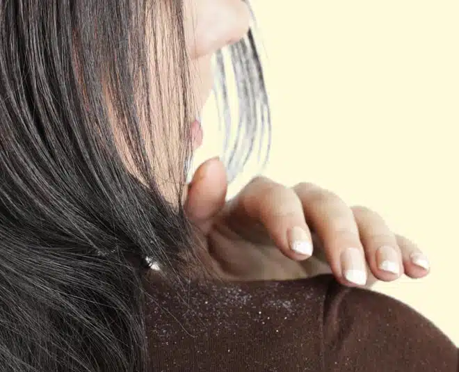 Tips to reduce dandruff