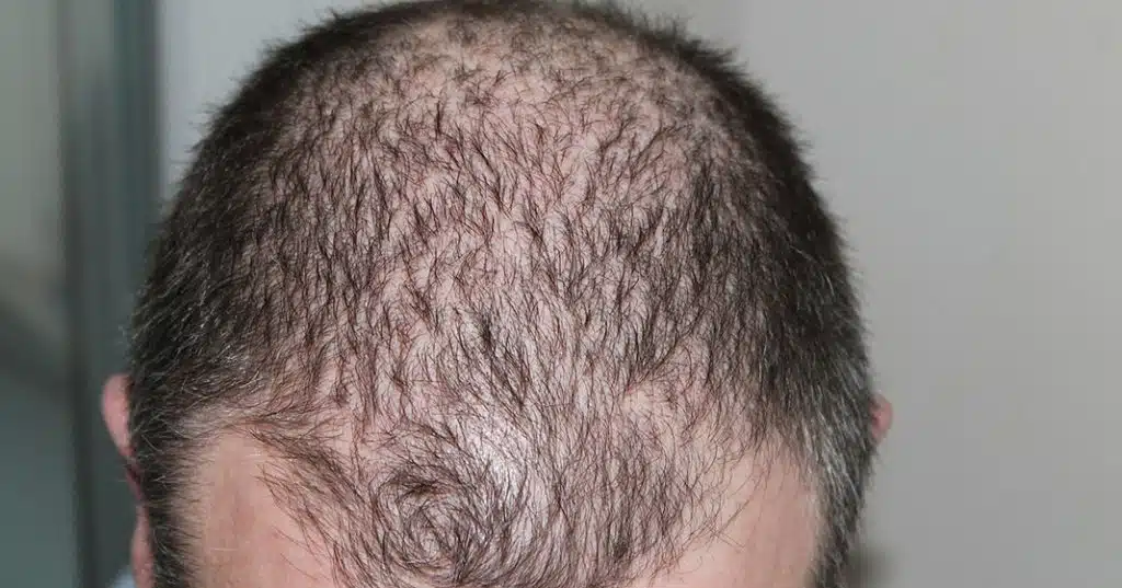 Hair loss