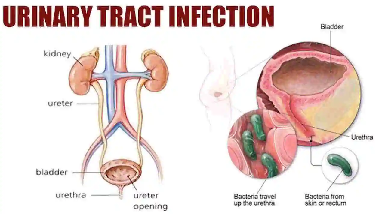 Urinary Tract Infection