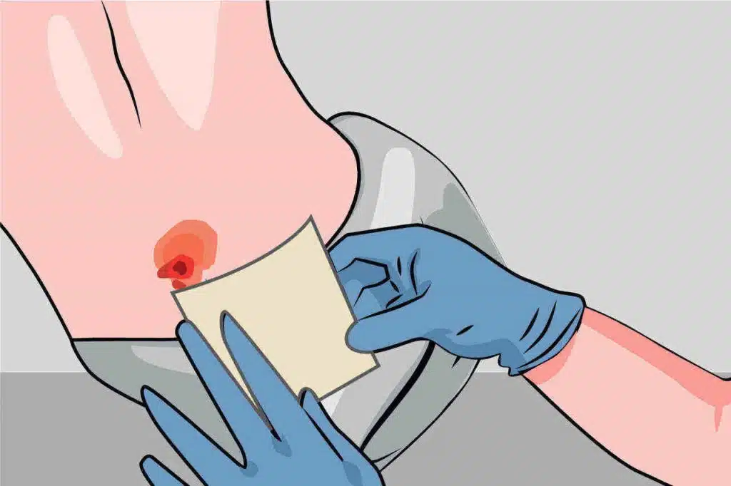 Wound Care Management