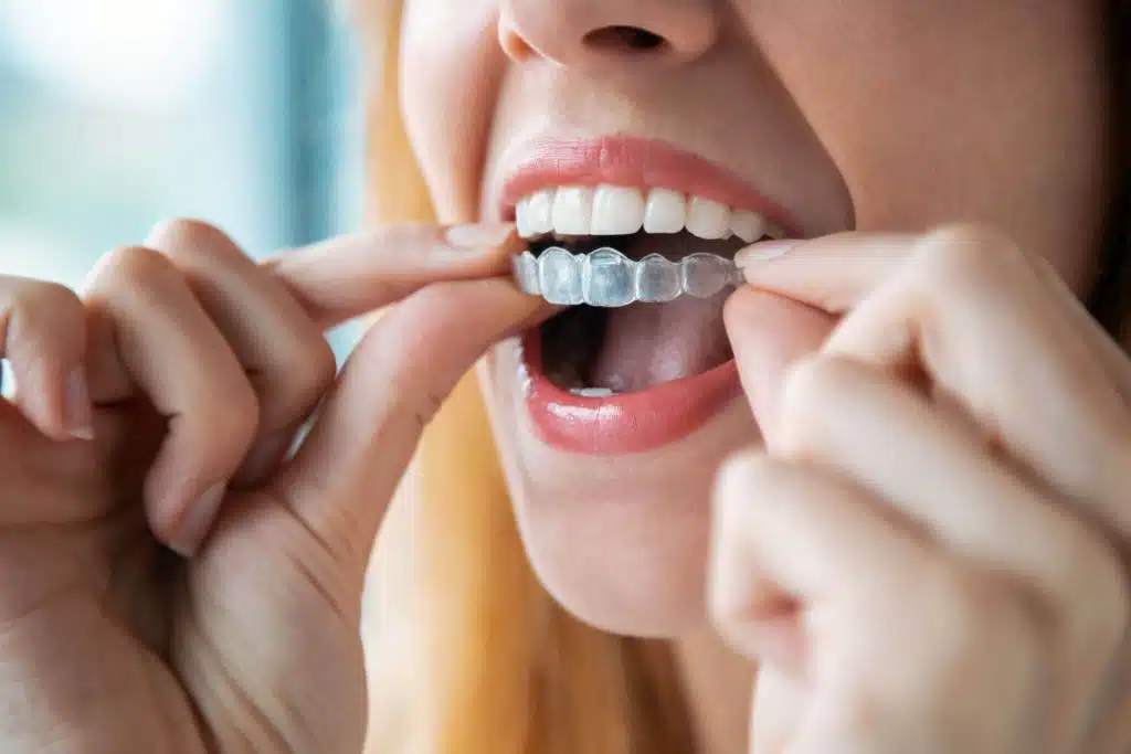Clean Invisalign Aligners