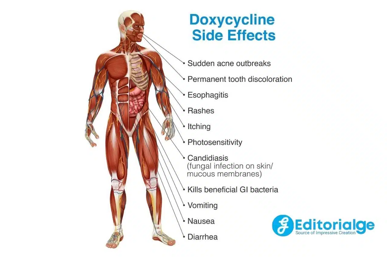 Side Effects of Doxycycline