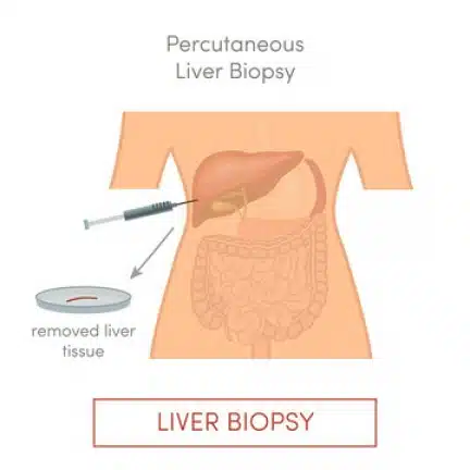 liver biopsy