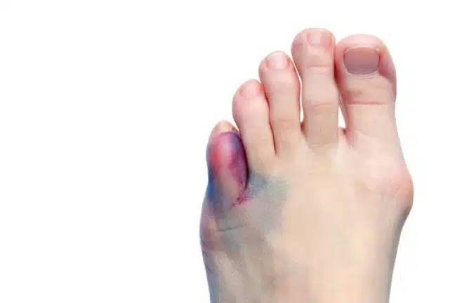 bruising toe after knee surgery