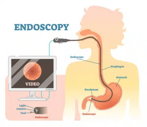 endoscopy
