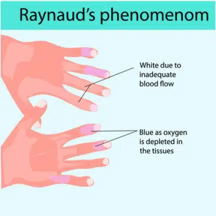 raynauds phenomenon