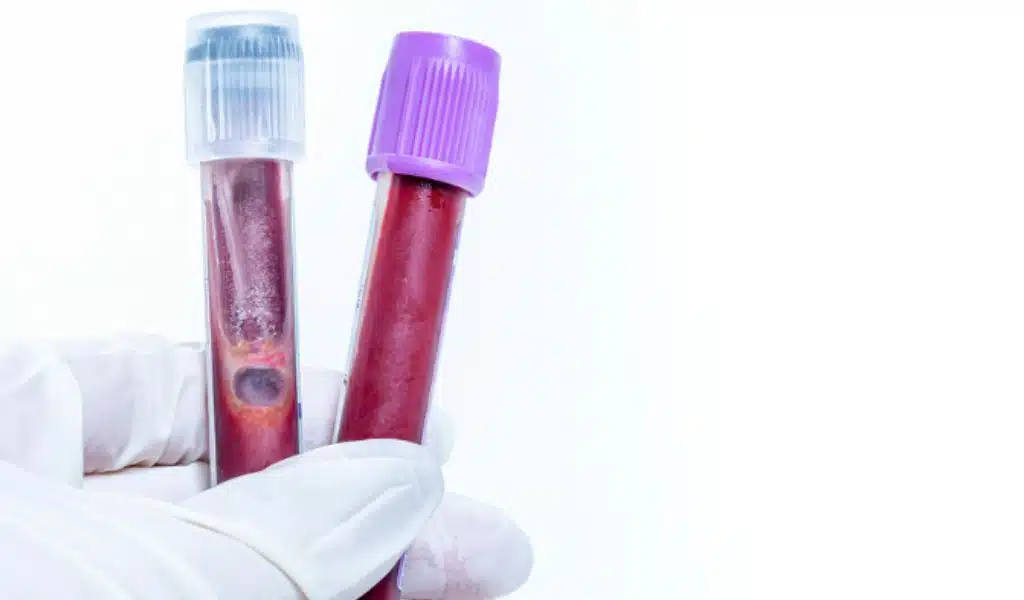 AI-based Blood Test to Detect Cancer