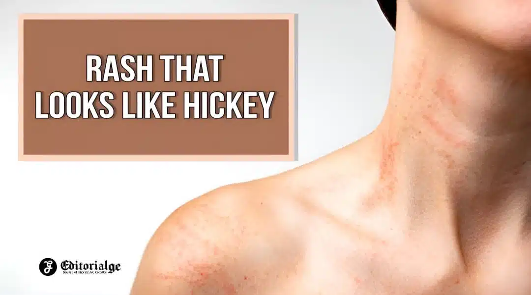 Rash that looks like hickey