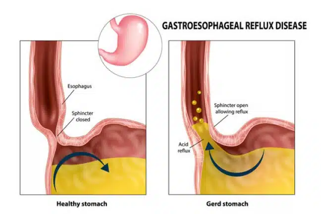 difference between a healthy and GERD stomach