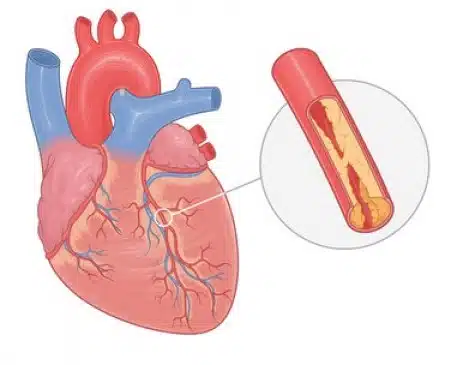 angina pectoris