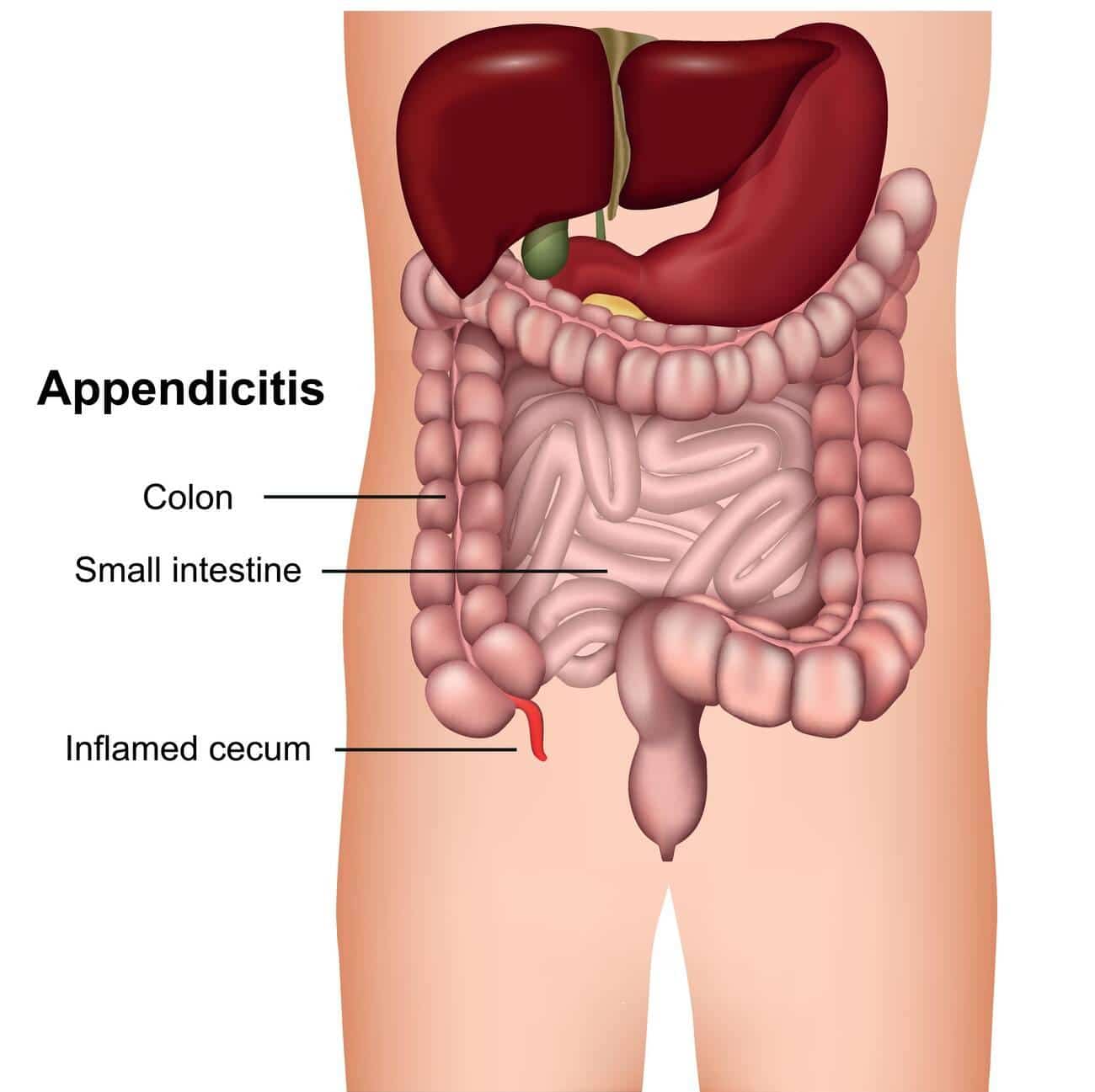 appendicitis