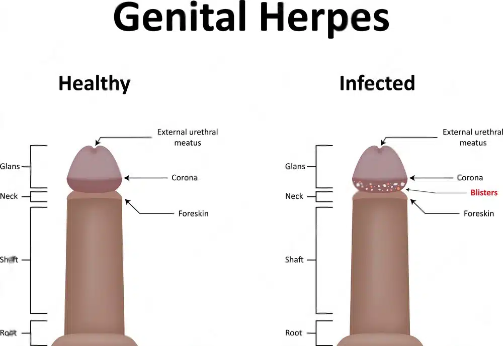 Healthy vs Infected Genital Herpes