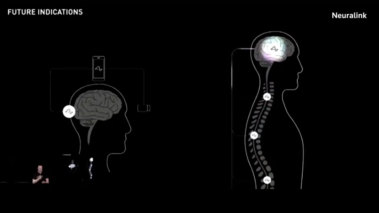 Neuralink Brain Implant Trial