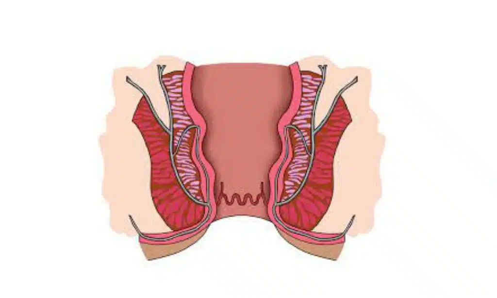 Proctalgia Fugax