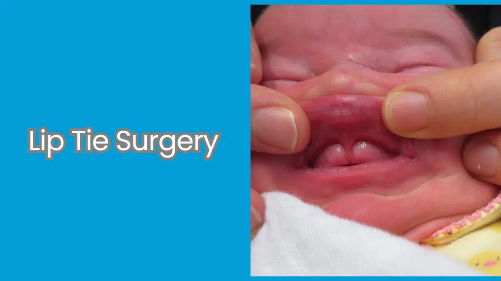 Lip Tie Surgery