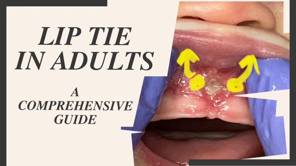 lip tie in adults