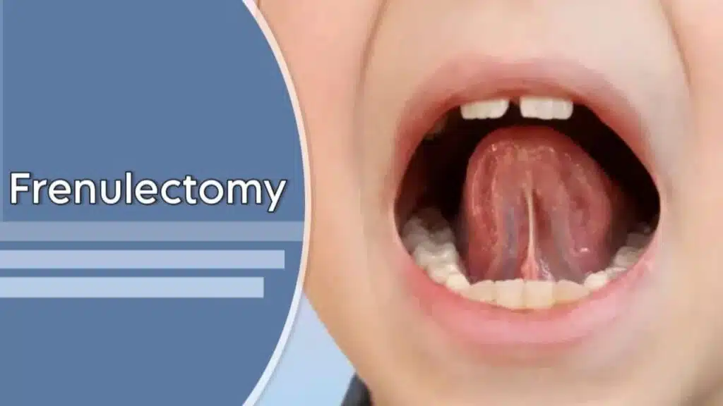 Frenulectomy
