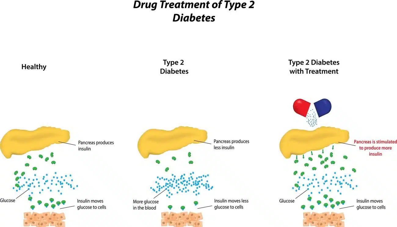 type 2 diabetes treatment