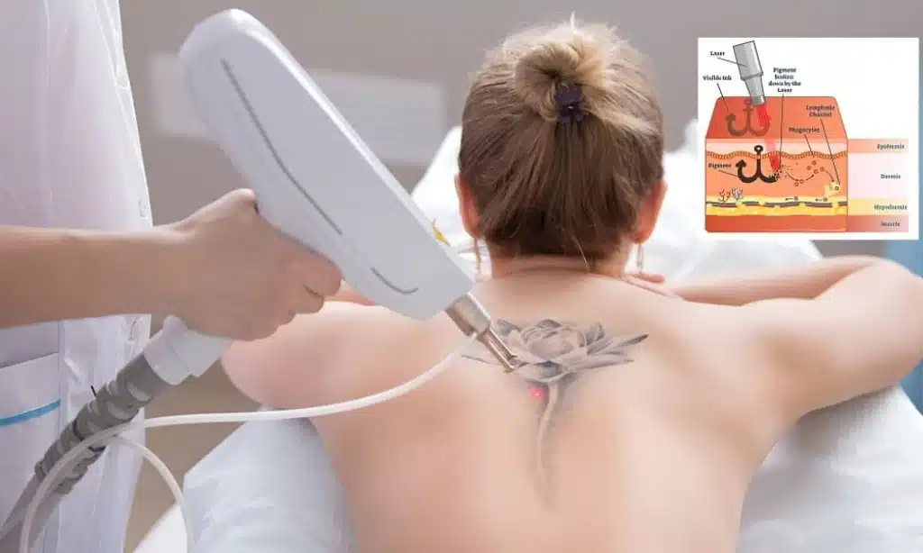 How Laser Tattoo Removal Works