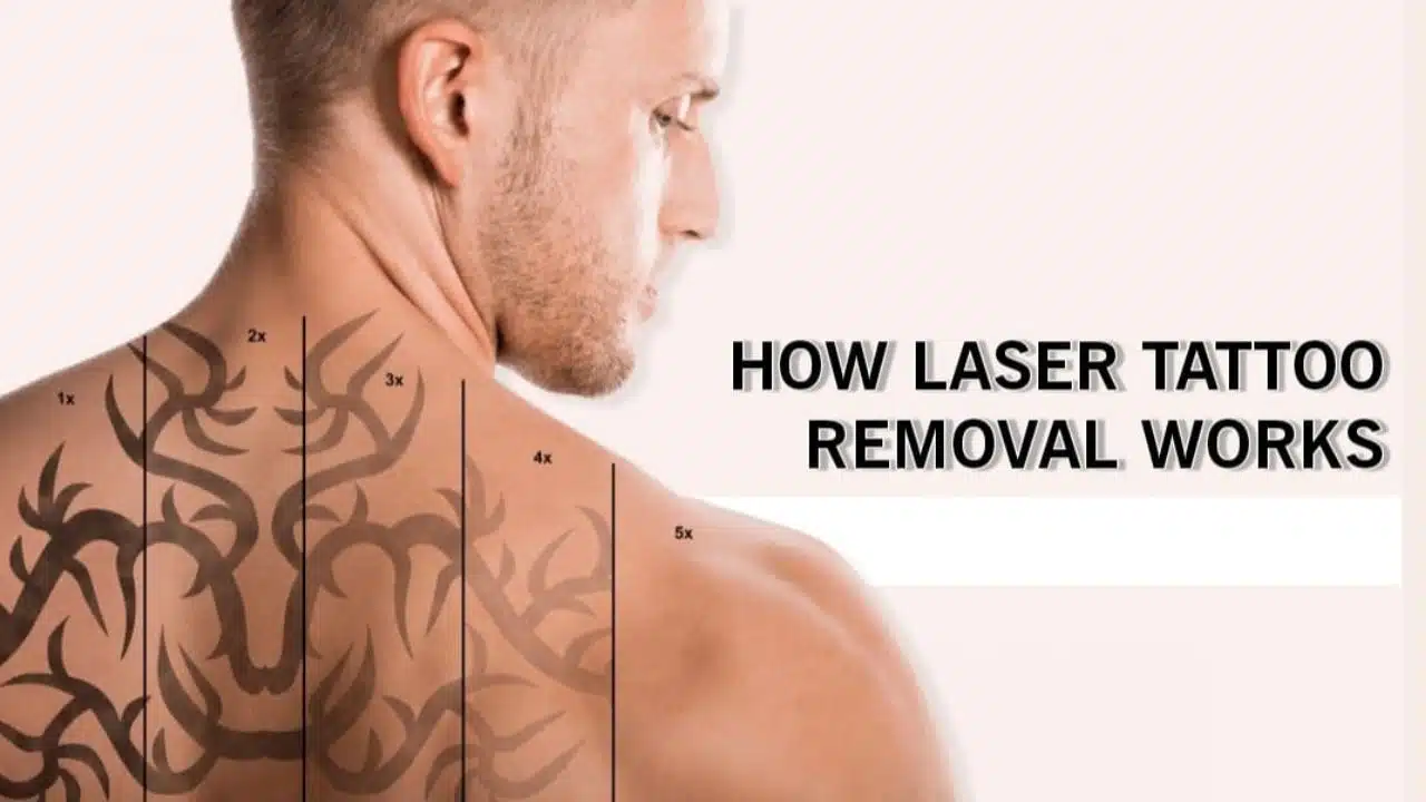 How Laser Tattoo Removal Works