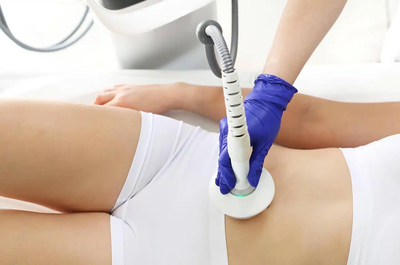 treatment of stretch marks