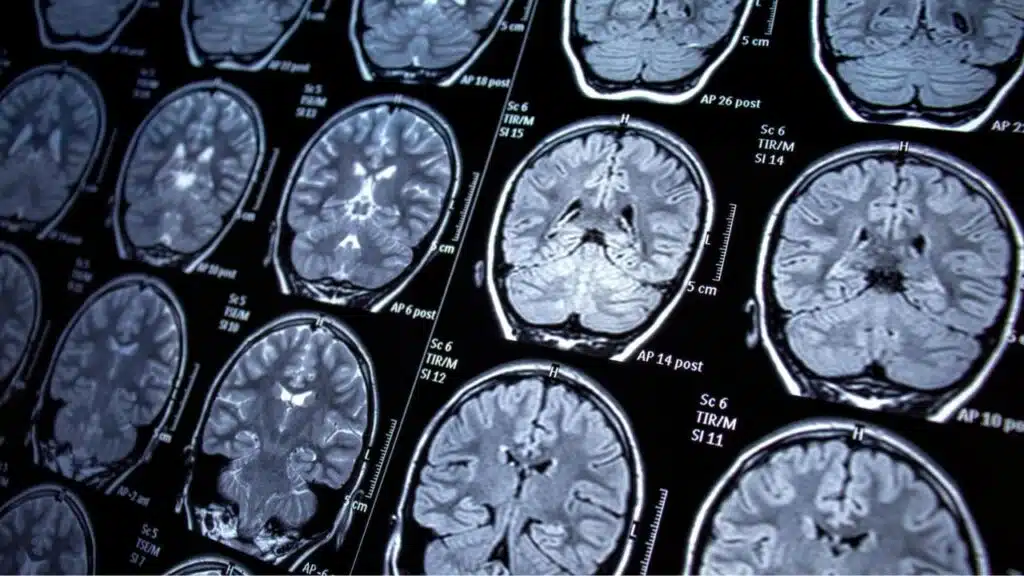 Magnetic resonance imaging - MRI