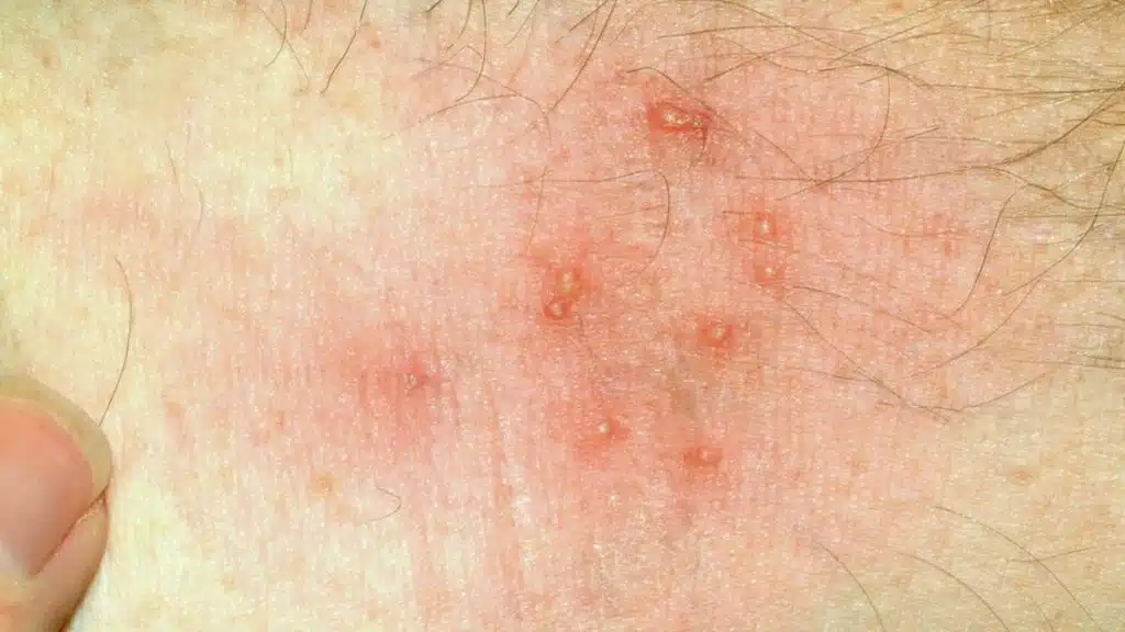 Home Remedies for Summer Itch