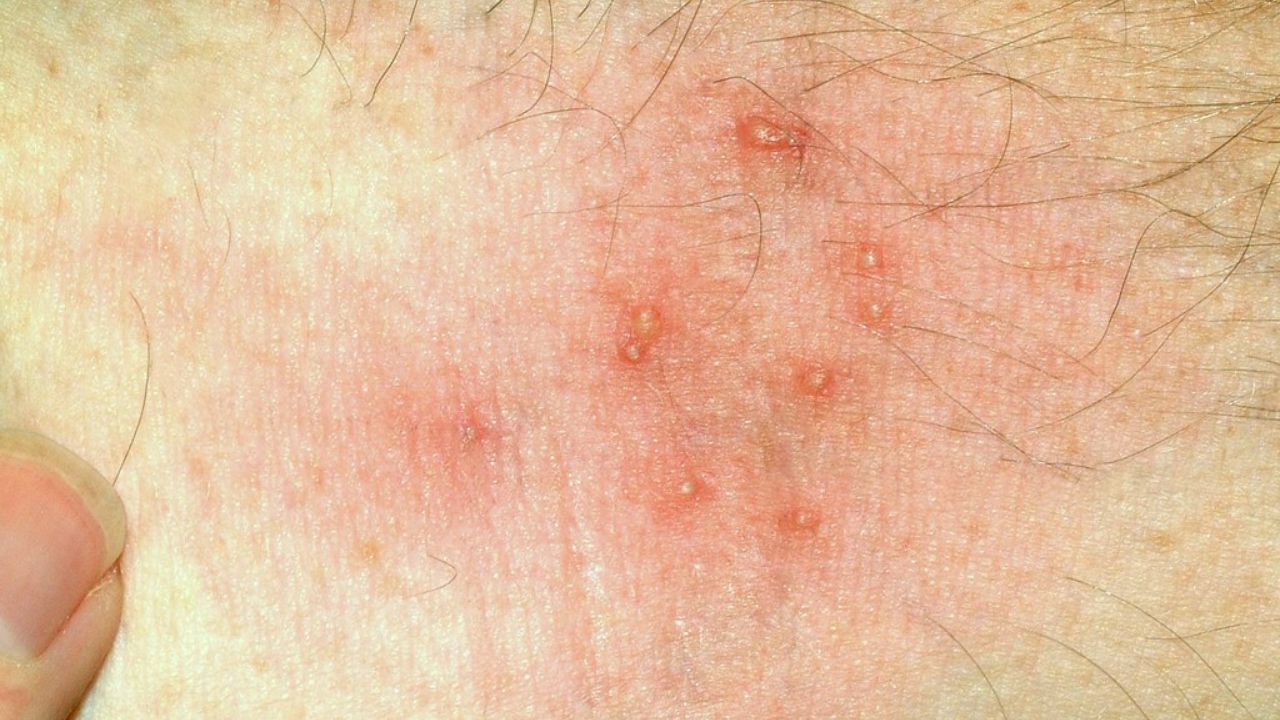 Home Remedies for Summer Itch