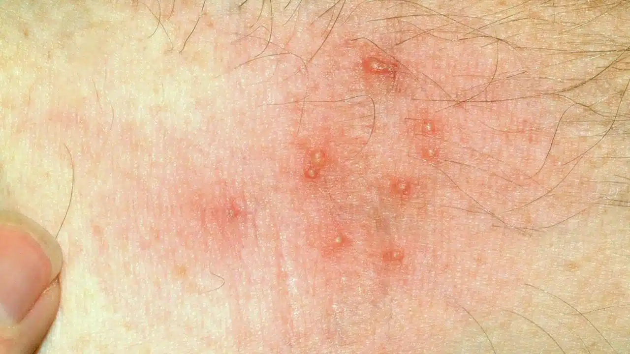 Home Remedies for Summer Itch