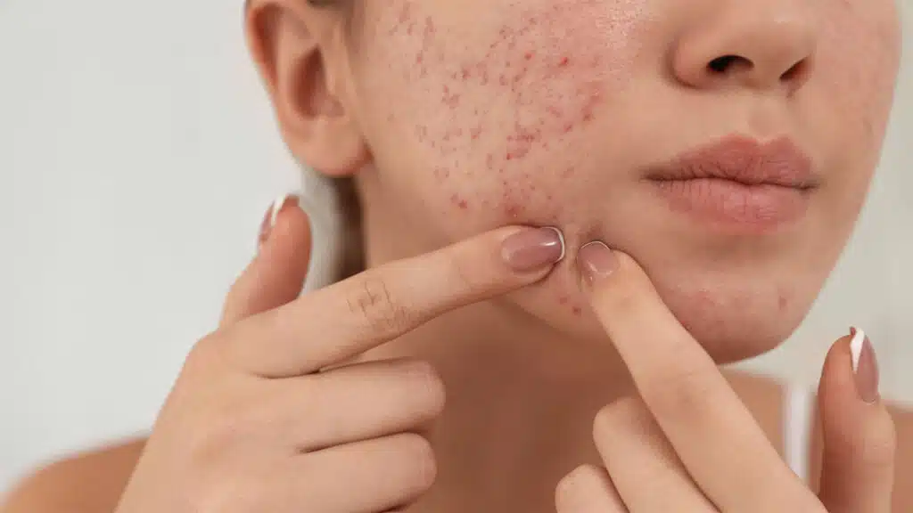 Understanding How Scar Creams Work