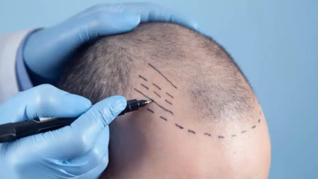 Advice to Meet the Best Hair Transplant Clinic in Turkey