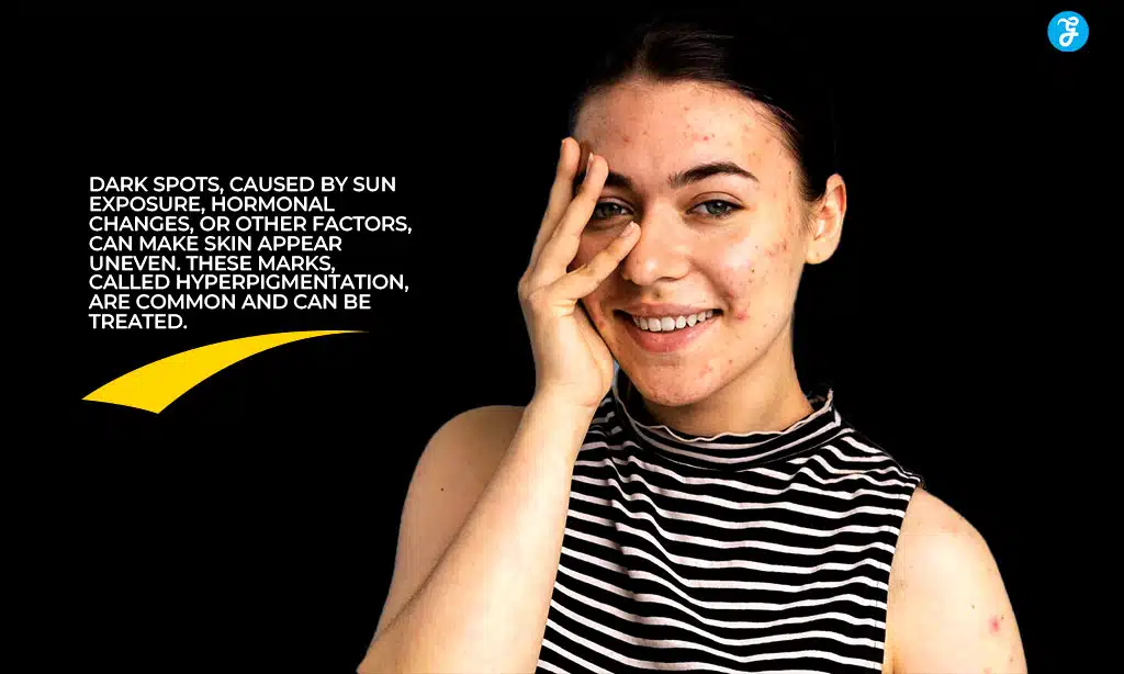 Understanding Dark Spots on the Face