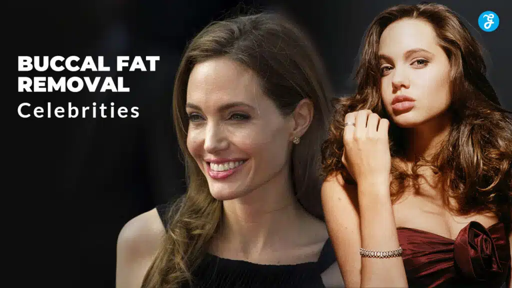 buccal fat removal celebrities
