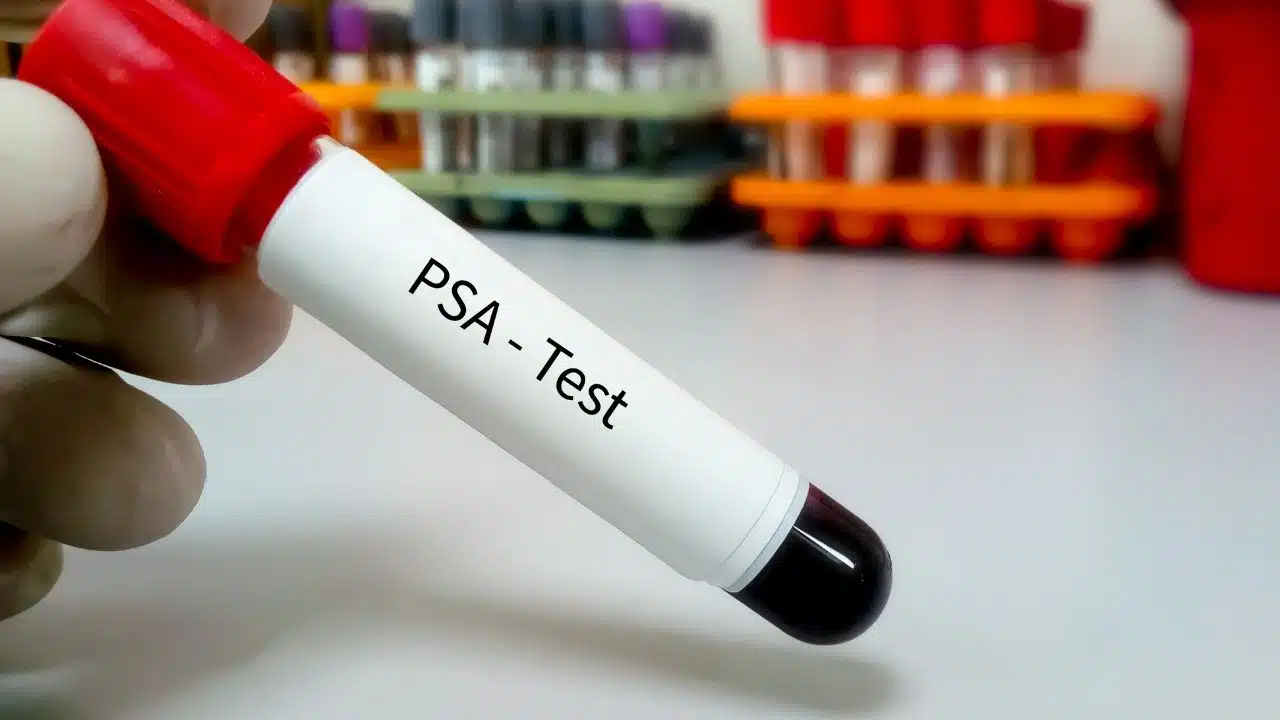 PSA Test
