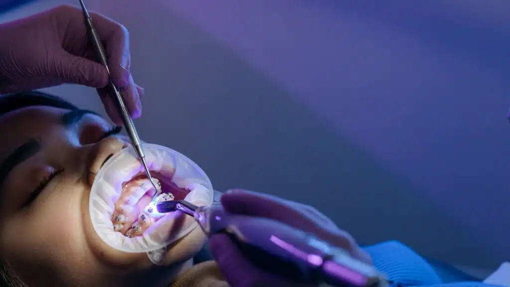 3 on 6 Dental Implants in Turkey