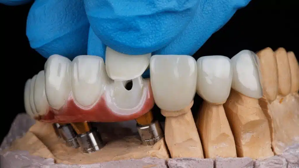 Best Veneers in Turkey