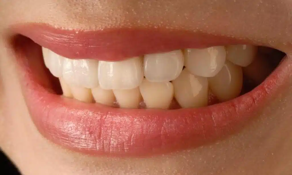 What Are Veneers