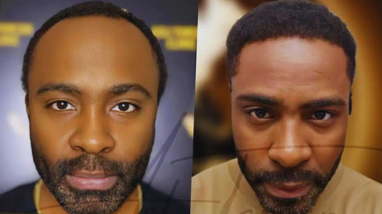 Best Afro Hair Transplant Turkey Clinics