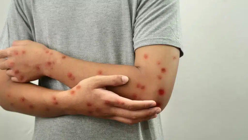 Clade 1 Mpox in US Wastewater