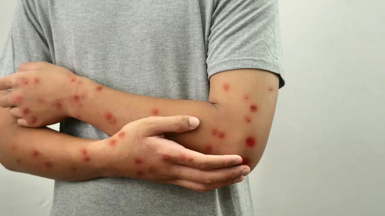 Clade 1 Mpox in US Wastewater