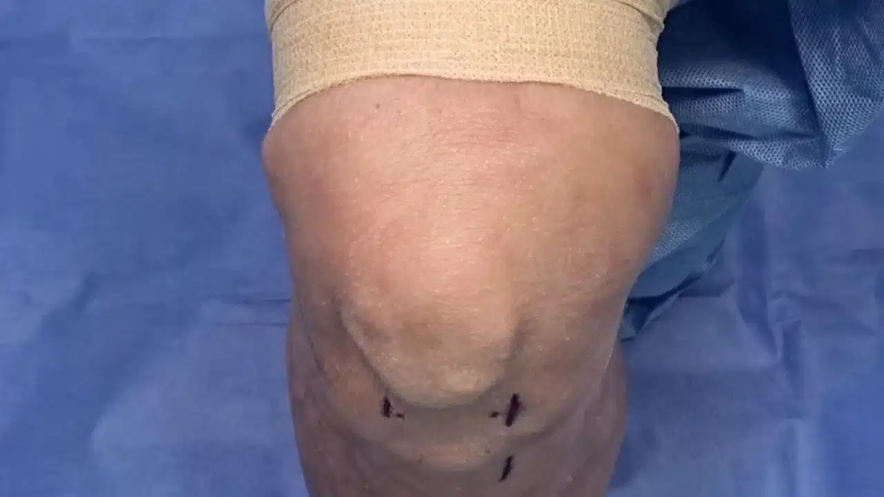 How an Allograft Tissue Saved My Life