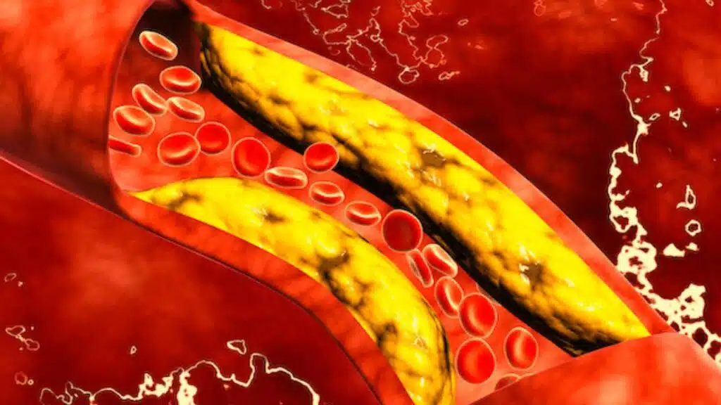 new cholesterol pill